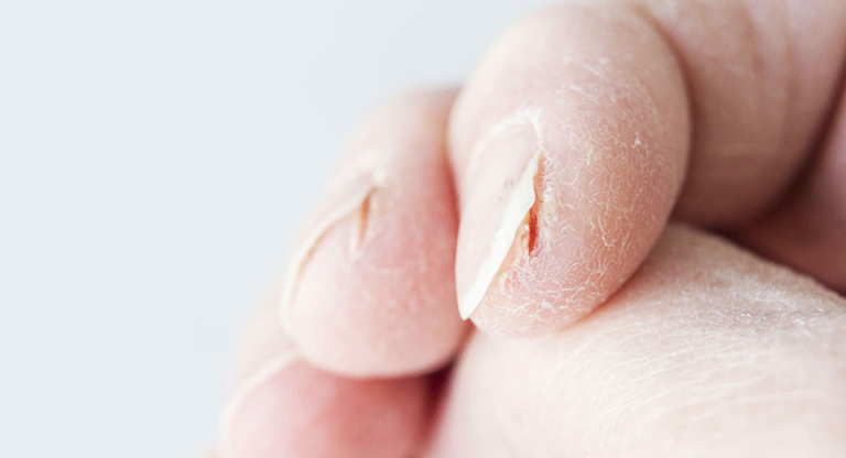Rissige Fingerkuppen - Pulpitis sicca behandeln | ptaDirekt