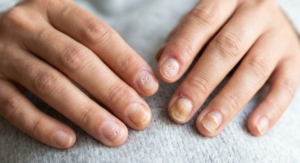 Nagelpsoriasis: Symptome, Behandlung und Tipps