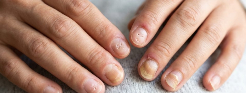 Nagelpsoriasis: Symptome, Behandlung und Tipps